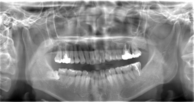 術前のレントゲン写真