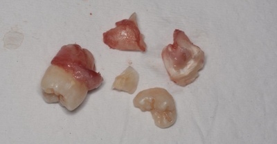 抜歯後の歯の写真