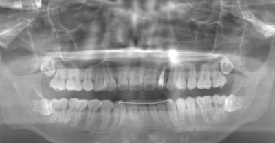 術前のレントゲン写真