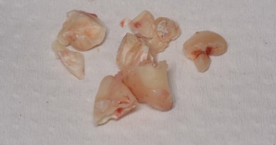 抜歯後の歯の写真