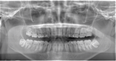 術前のレントゲン写真