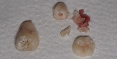 抜歯後の歯の写真