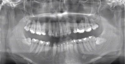 術前のレントゲン写真