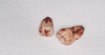 抜歯後の歯の写真