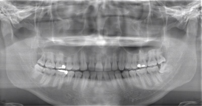 術前のレントゲン写真