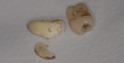 抜歯後の歯の写真