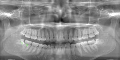 術前のレントゲン写真