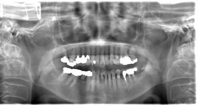 術前のレントゲン写真