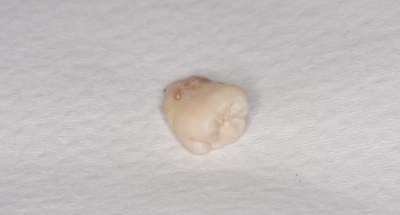 抜歯後の歯の写真