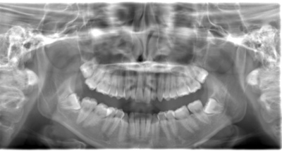 術前のレントゲン写真