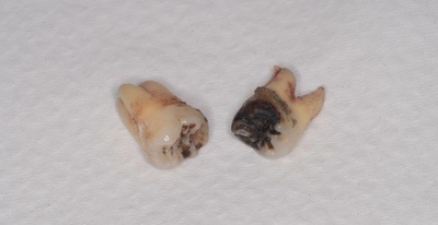 抜歯後の歯の写真