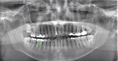 術前のレントゲン写真
