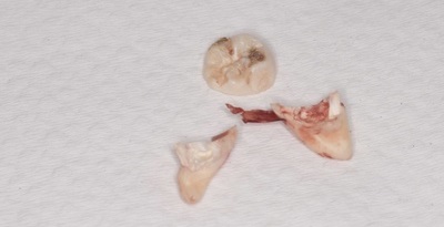 抜歯後の歯の写真