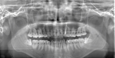 術前のレントゲン写真