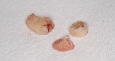 抜歯後の歯の写真