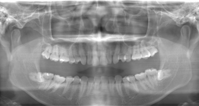 術前のレントゲン写真