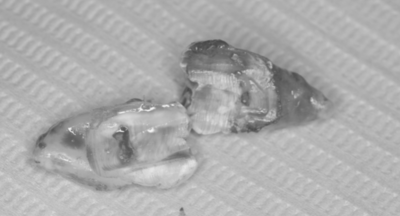 抜歯後の歯の写真