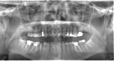 術前のレントゲン写真
