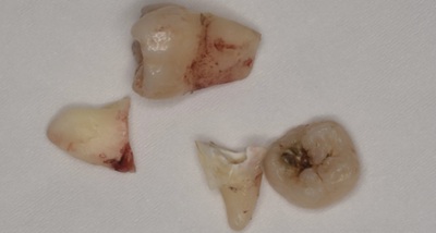 抜歯後の歯の写真