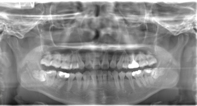 術前のレントゲン写真