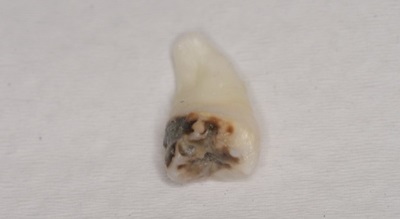 抜歯後の歯の写真