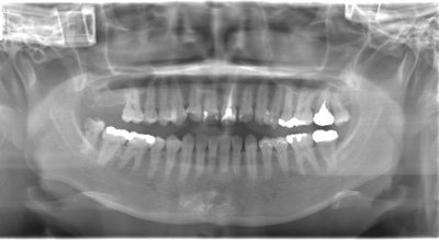 術前のレントゲン写真