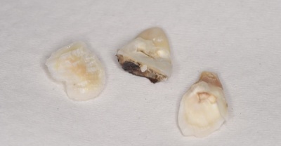 抜歯後の歯の写真