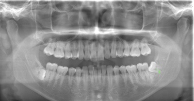 術前のレントゲン写真