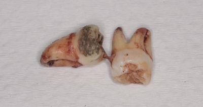 抜歯後の歯の写真