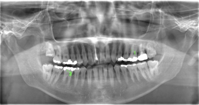術前のレントゲン写真