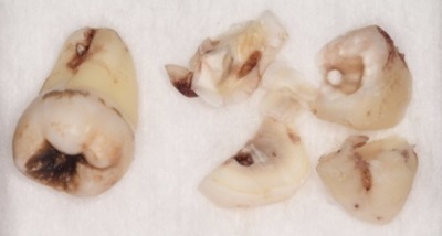 抜歯後の歯の写真