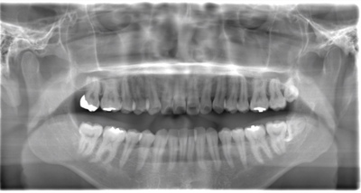 術前のレントゲン写真