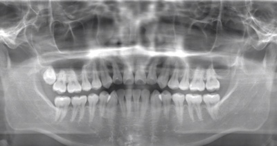 術前のレントゲン写真