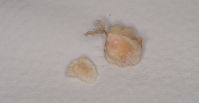 抜歯後の歯の写真