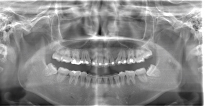 術前のレントゲン写真