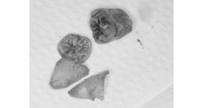 抜歯後の歯の写真