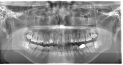 術前のレントゲン写真