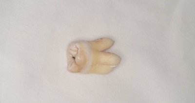 抜歯後の歯の写真