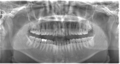 術前のレントゲン写真