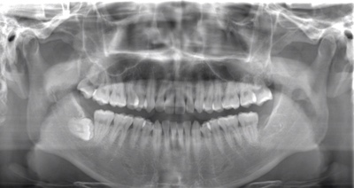 術前のレントゲン写真