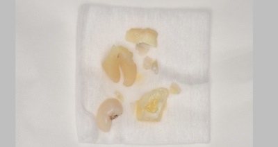 抜歯後の歯の写真