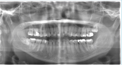 術前のレントゲン写真
