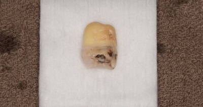 抜歯後の歯の写真