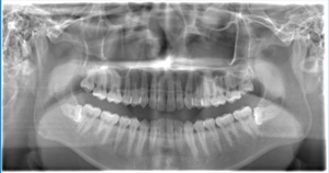術前のレントゲン写真